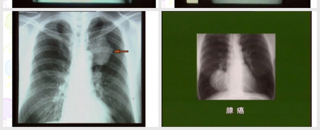 原发性支气管肺癌PPT模板