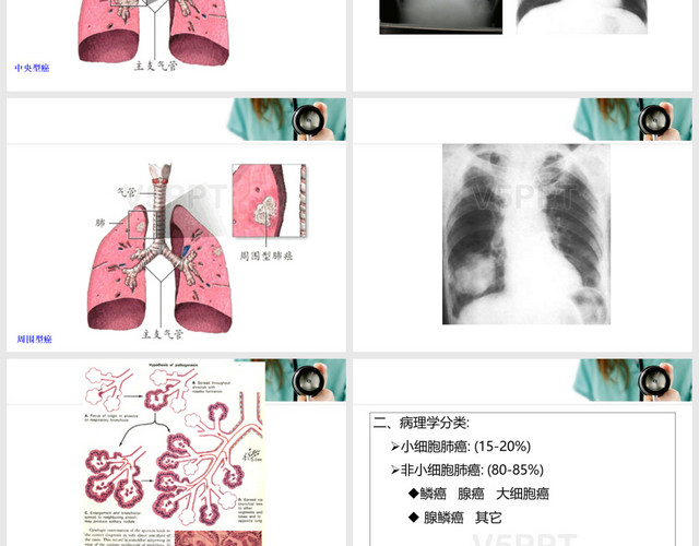 肺癌护理查房模板PPT