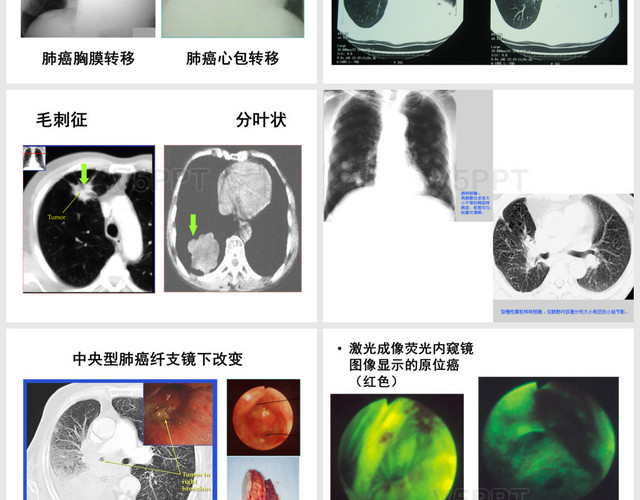 肺癌的诊断与治疗PPT模板
