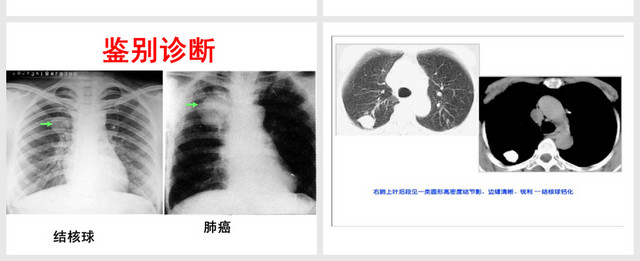 肺癌的诊断与治疗PPT模板