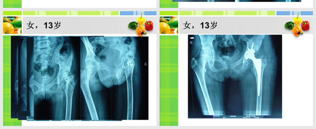 有關股骨頸骨折PPT模板