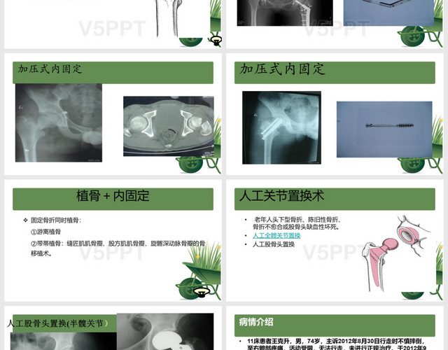 股骨頸骨折內(nèi)容PPT